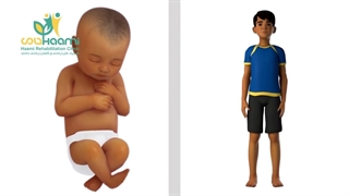 بهترین روش های درمان و پیشگیری از دررفتگی لگن در کودکان فلج مغزی