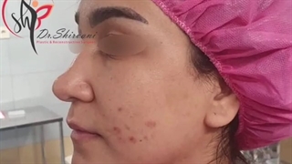 فیلم جراحی ترمیم بینی بلافاصله پس از عمل