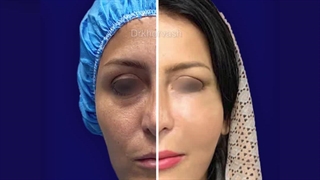 فیلم رضایت بیمار از تزریق چربی