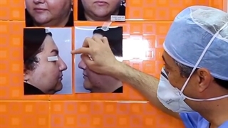 عمل بینی گوشتی در قزوین