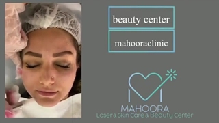 میکرودرم ابریژن، موثرترین روش جوانسازی و لایه برداری