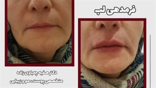 فیلم حجم دهی لب