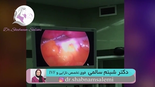 لاپاراسکوپی حاملگی خارج رحمی