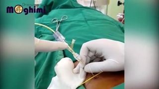 فیلم بدون سانسور عمل جراحی لیزری دیسک کمر در بیمار ۴۸ ساله