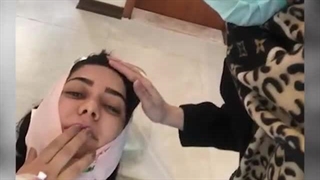 فیلم بلافاصله بعد از لیپوساکشن غبغب بدون درد و کاملا هوشیار