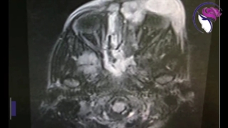 فیلم جراحی آندوسکوپی