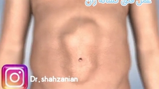 عمل فتق کشاله ران