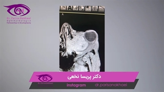 ویدئو عمل واقعی تومور همانژیوپریسیتوما وسیع