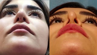 فیلم قبل و بعد چند نمونه از عمل های ترمیمی بینی