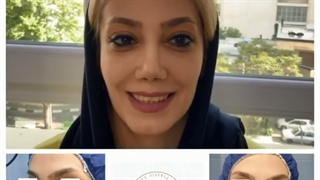 دو ماه بعد از جراحی زیبایی بینی