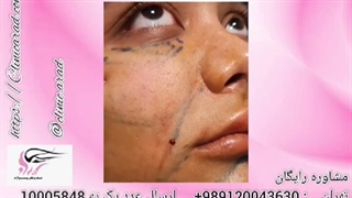 کسانی که تزریق چربی داشتند ارتودنسی