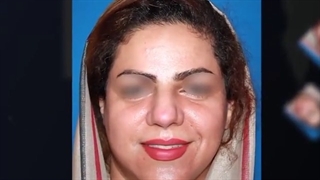 فیلم عمل بینی گوشتی با پوست ضخیم بعد از 6 ماه