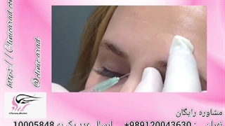 تزریق ژل بهتر است یا بوتاکس رفع غبغب