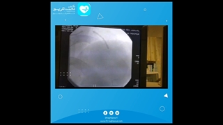 آنژیوپلاستی در بیماری با درد قفسه سینه و ناتوانی در انجام فعالیت های روزانه