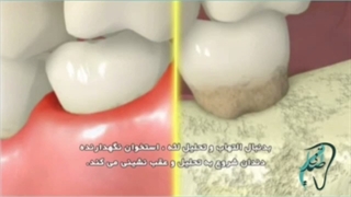 التهاب لثه ترمیم سوختگی