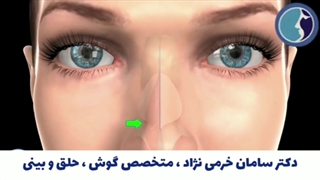 انیمیشنی در رابطه با تیغه بینی و اصلاح آن