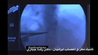 دکتر رضا جباری پر کردن دندان