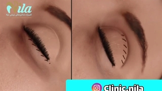 جراحی بلفاروپلاستی