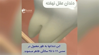 جراحی دندان عقل