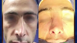 فیلم جراحی بینی ترمیمی