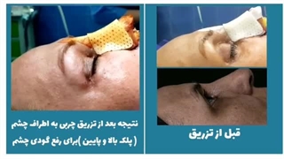 فیلم رفع گودی چشم با تزریق چربی