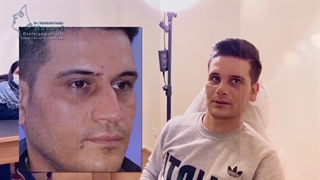 جراحی بینی مردانه نیمه فانتزی