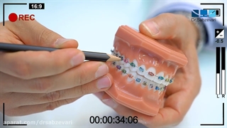 آشنایی بااجزای دستگاه ارتودنسی ثابت