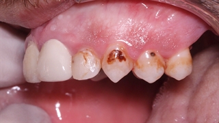 تکنیک جدید کامپوزیت | کلینیک سیمادنت