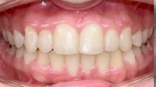 درمان ارتودنسی ثابت دو فک بدون کشیدن دندان | کلینیک تخصصی دندانپزشکی کانسپتا