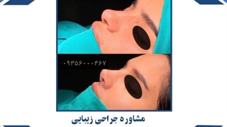 عمل زیبایی بینی در مشهد