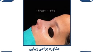 جراحی زیبایی عمل بینی در مشهد