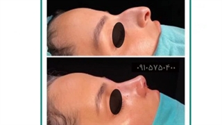 جراحی زیبایی بینی در مشهد