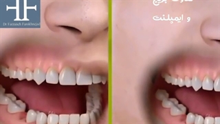 تفاوت بریج و ایمپلنت