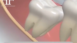 دندان عقل نهفته