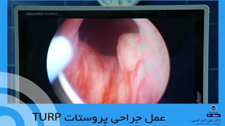 عمل جراحی پروستات TURP
