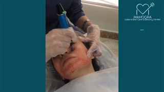 فیلم واقعی مزونیدلینگ، معجزه جوانسازی صورت