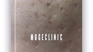 بهترین دکتر درمان جای جوش