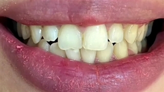 نتیجه کامپوزیت دندان