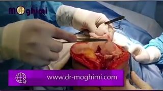 فیلم بدون سانسور تعویض مفصل زانوی راست - پارت اول