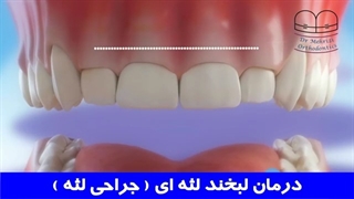 درمان لبخند لثه ای (جراحی لثه) | دکتر احسان مهریزی