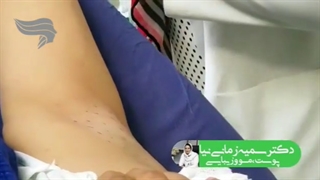 بوتاکس زیر بغل | دکتر سمیه زمانی نیا لیفت گردنایمپلنت دندان