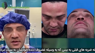 جراحی اولیه بینی زینی شکل با سابقه ضربه به بینی | دکتر باستانی نژاد