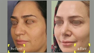 نمونه جراحی ترکیبی رینو و بلفاروپلاستی | دکتر سهراب مرادی