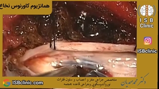 همانژیوم کاورنوس نخاع