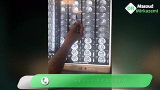 خارج سازی تومور