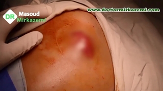 فیلم خارج سازی تومور سارکوم شانه