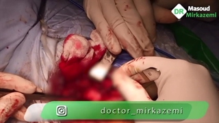 عمل جراحی در رفتگی مادرزادی لگن