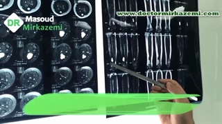 خارج سازی تومور کیستیک استخوانی