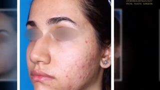نمونه کارهای عمل بینی دکتر نسرین راستا کاشت ابرو