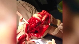 فیلم واقعی خارج سازی تومور استئوسارکوم استخوان